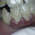 Gum Disease/ Periodontal Disease