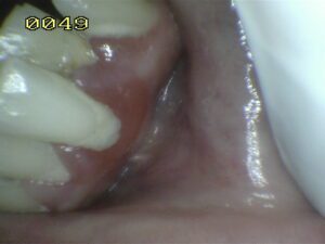 Gum Disease- Periodontal disease