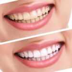 Teeth Whitening- Teeth Bleaching