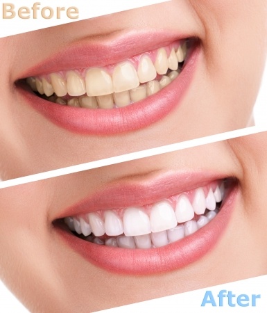 Teeth Whitening: What you should know