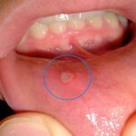 mouth lesion