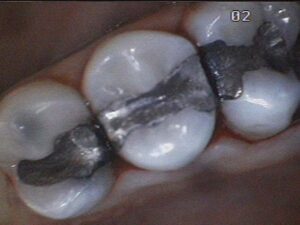 Amalgam Silver Fillings