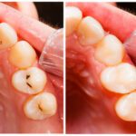 Composite Tooth-colored Fillings