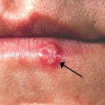 Herpes or cold sore