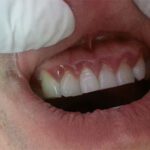 Gingivitis and Bleeding gums
