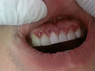 Gum disease or Gingivitis