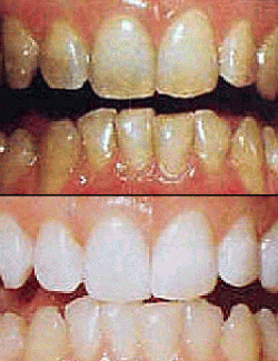 Teeth Bleaching Before And After Smoking