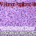 Human Papilloma Virus- HPV