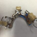 Partials for teeth replacement