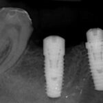 Dental Implants teeth replacement