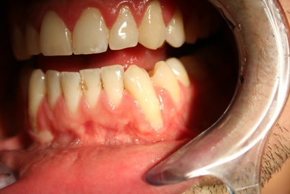 treatment of gum recession